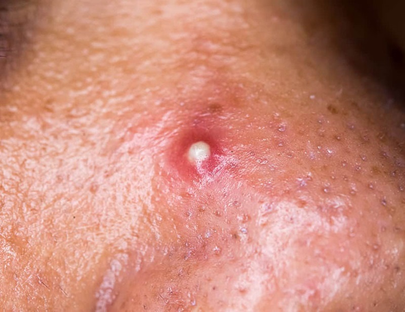 mụn đầu đinh viêm nhiễm