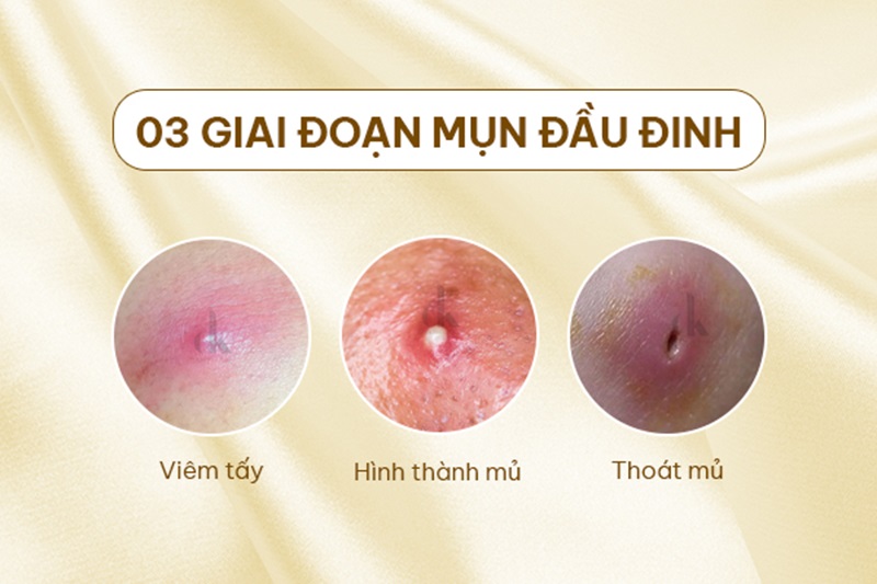 giai đoạn phát triển của mụn đầu đinh