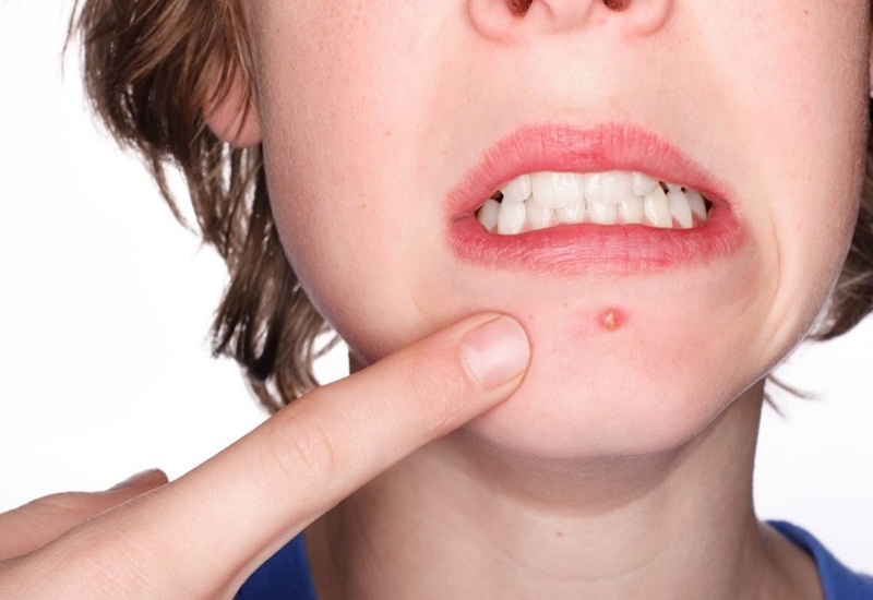 mụn đầu đinh ở cằm