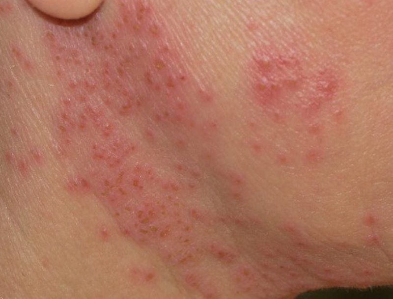 dấu hiệu nhận biết nổi mụn do dị ứng​