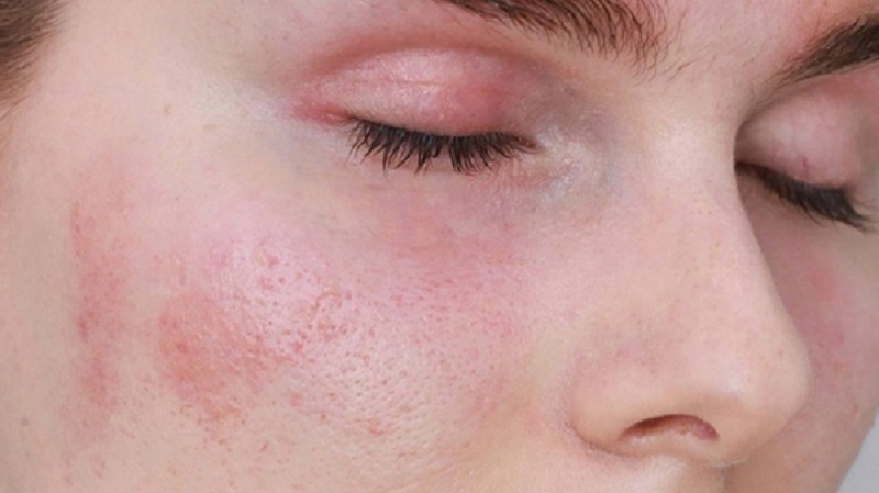 Nhận biết mụn dị ứng