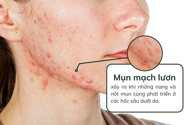 nguyên nhân gây mụn mạch lươn