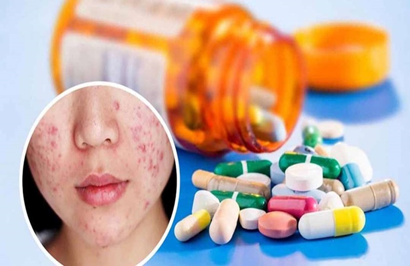 điều trị mụn mạch lươn bằng thuốc