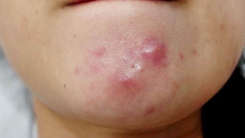 Hình ảnh nụn nang gây sưng viêm