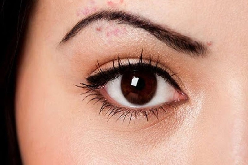 Mụn ở chân mày