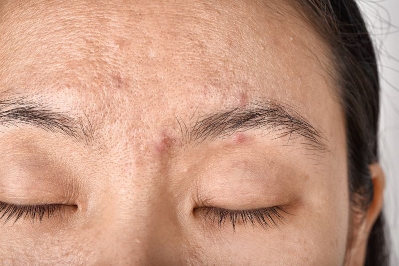 Mụn ở chân mày