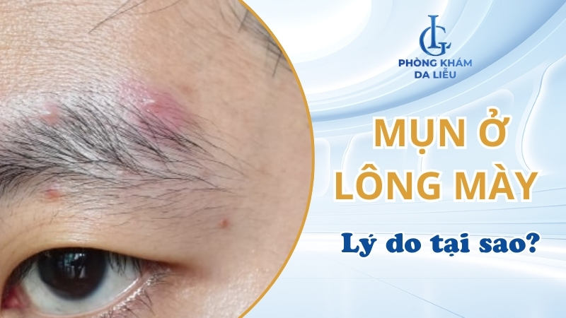 mụn ở lông mày