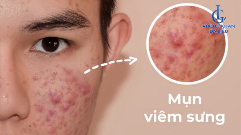 mụn viêm​ sưng đỏ