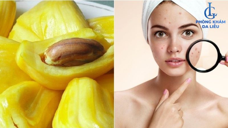 Ăn mít nhiều có gây nổi mụn không