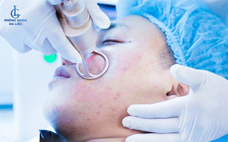 Trị mụn bằng Laser