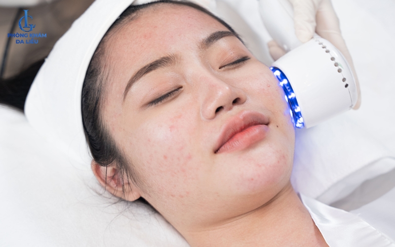 Giá điều trị mụn tại spa