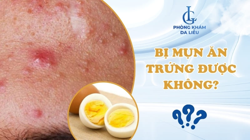 Bị mụn ăn trứng được không