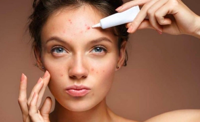 bôi thuốc trị mụn viêm đỏ​