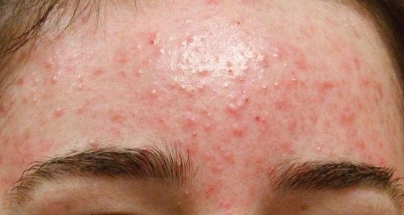 đẩy mụn ở trán