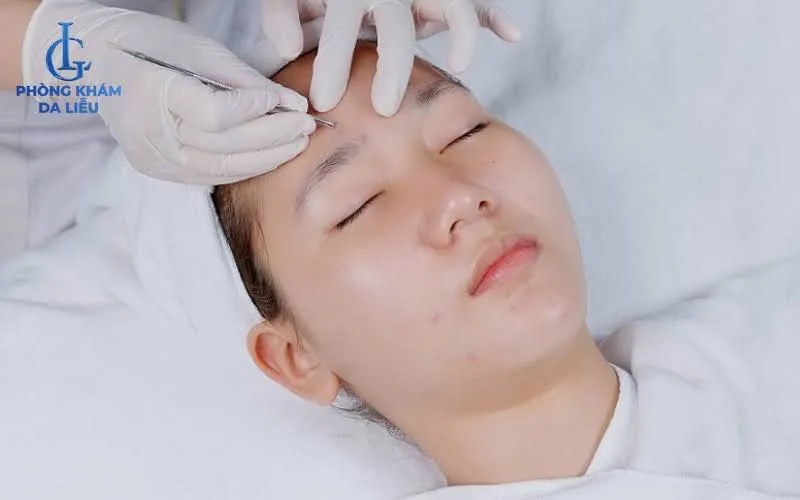 Lấy nhân mụn là giải pháp điều trị mụn hiệu quả, nhanh chóng