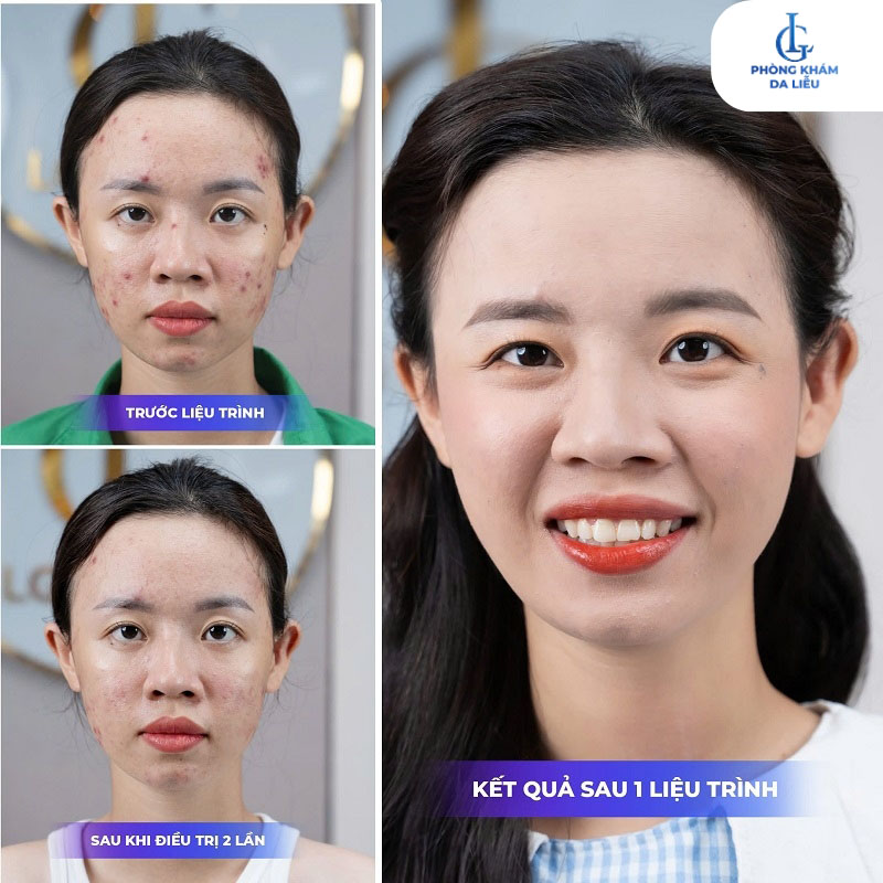 Hình ảnh trước và sau khi điều trị mụn tại phòng khám LG