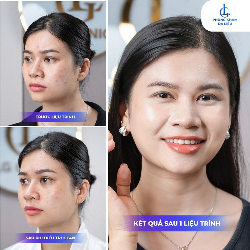 Hình ảnh trước và sau khi điều trị mụn tại phòng khám da liễu LG