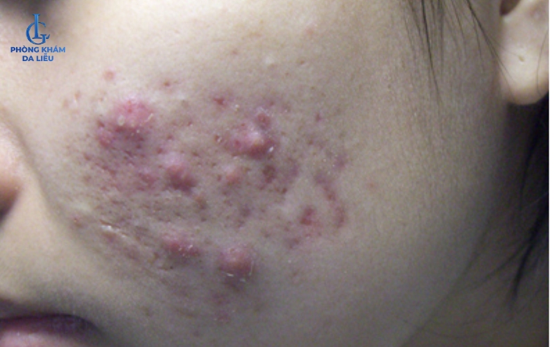 Hình ảnh bị mụn bọc