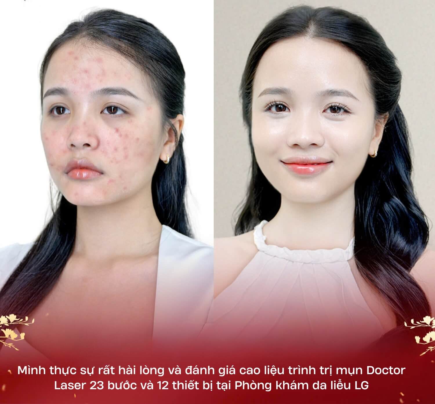 Chị Yên Đan trị mụn tại phòng khám LG