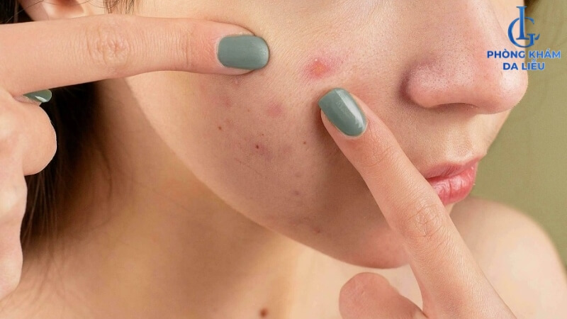 Bị nổi mụn khi đến tháng