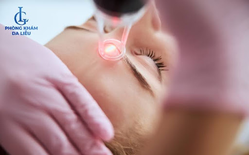 Laser là giải pháp loại bỏ nhân mụn bằng công nghệ ánh sáng