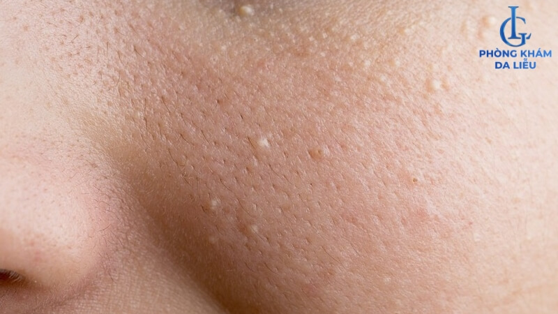 Nguyên nhân gây mụn ẩn