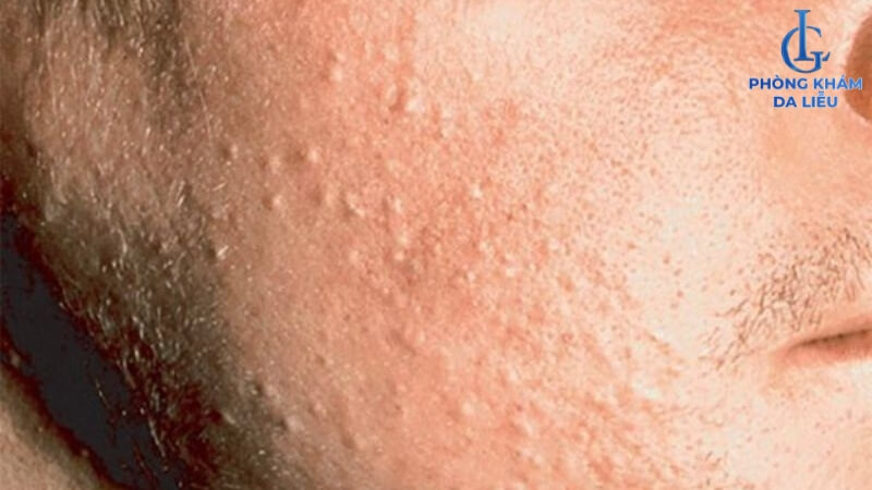 Dấu hiệu nhận biết mụn ẩn