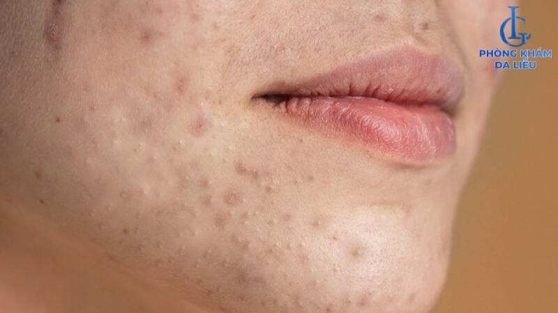 Các vị trí mụn ẩn xuất hiện