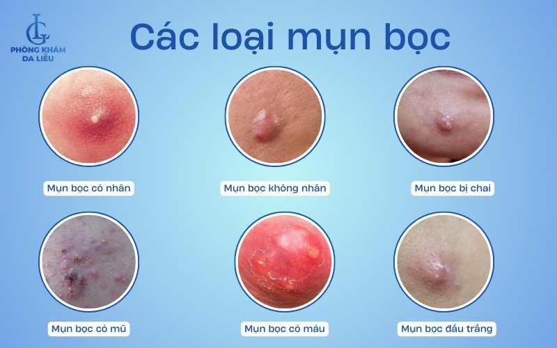 Các loại mụn bọc