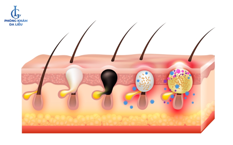 Hình ảnh 3D các giai đoạn phát triển của mụn bọc