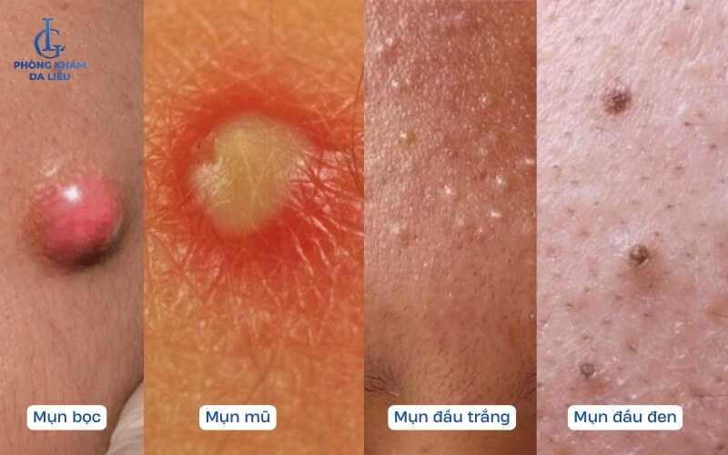 Hình ảnh so sánh mụn bọc và các loại mụn khác