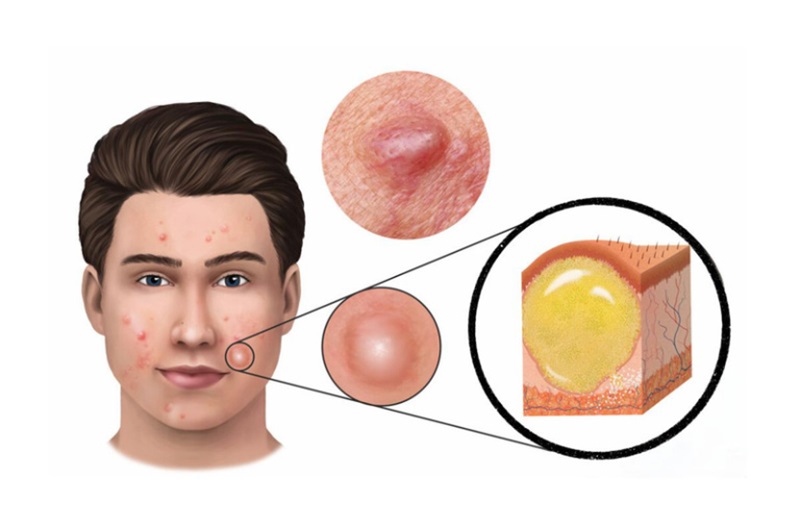 giai đoạn hình thành mụn chai