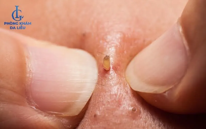 Các loại mụn có cồi hoặc bị chay lì lâu ngày trên da cần thực hiện lấy nhân mụn