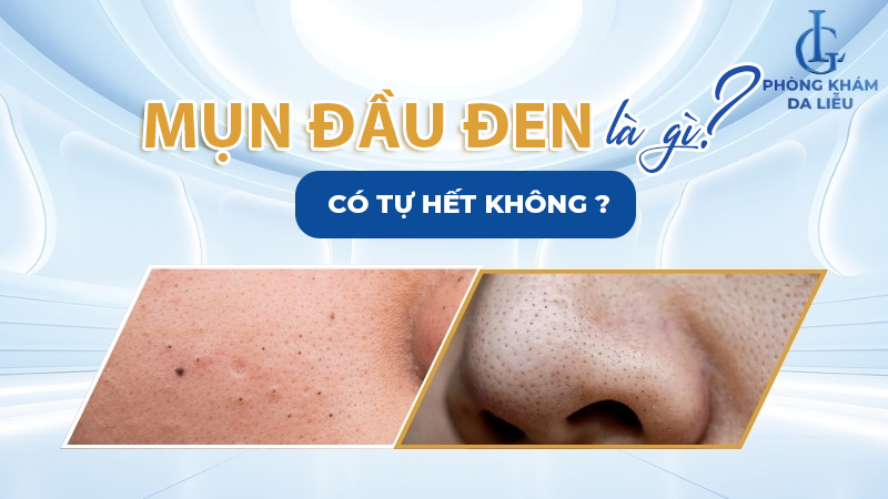 Mụn đầu đen là gì