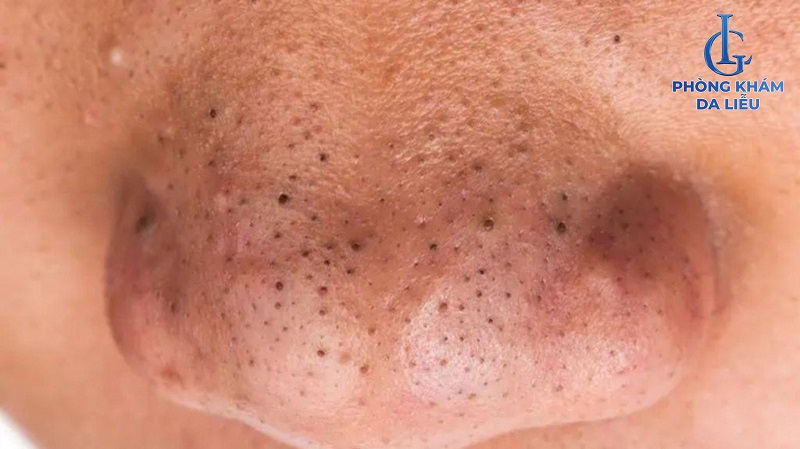 Hình ảnh mụn đầu đen ở mũi
