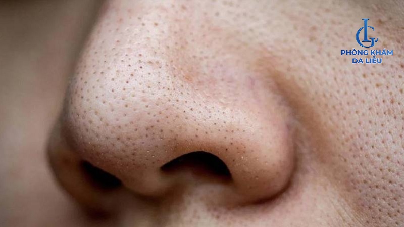 Hình ảnh mụn đầu đen li ti và dày đặc