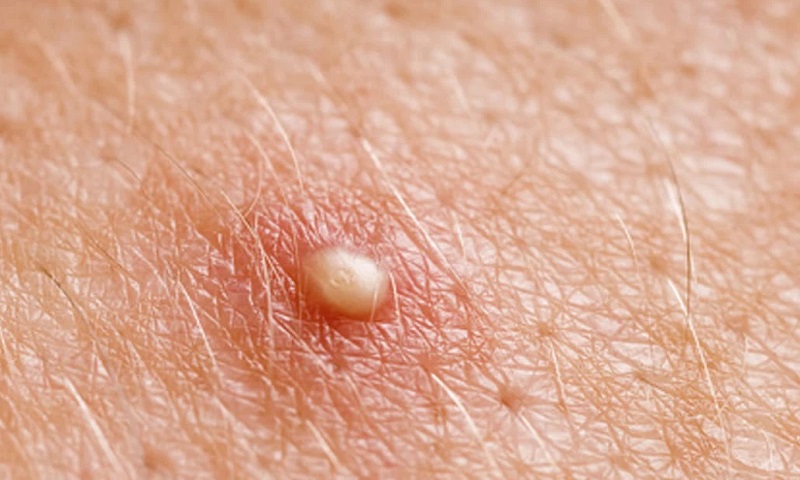 Nguyên nhân gây ra mụn đầu trắng