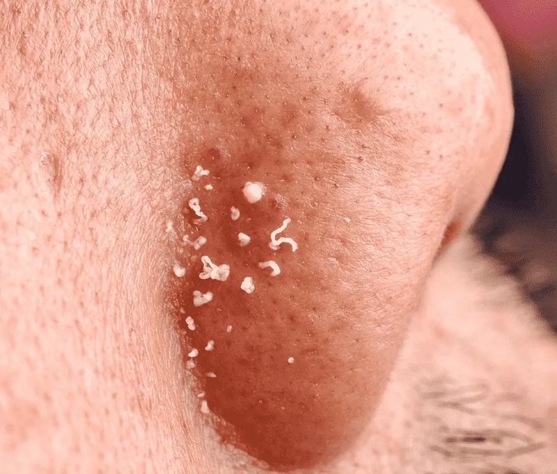 mụn đầu trắng là gì