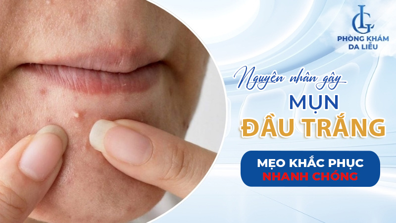 Mụn đầu trắng