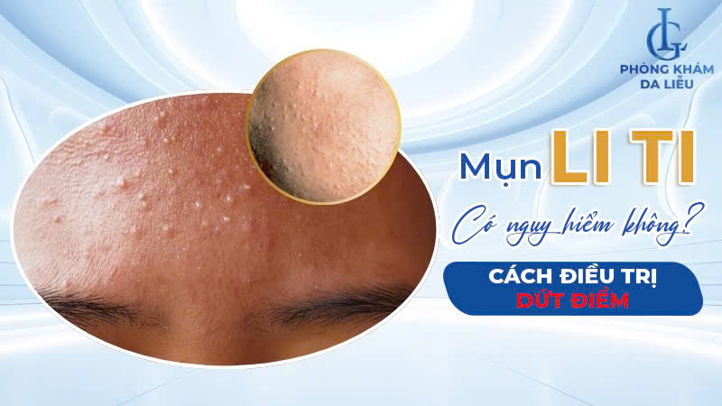 mụn li ti