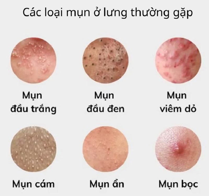 Hình ảnh các loại mụn lưng giúp nhận diện đặc điểm của từng loại mụn