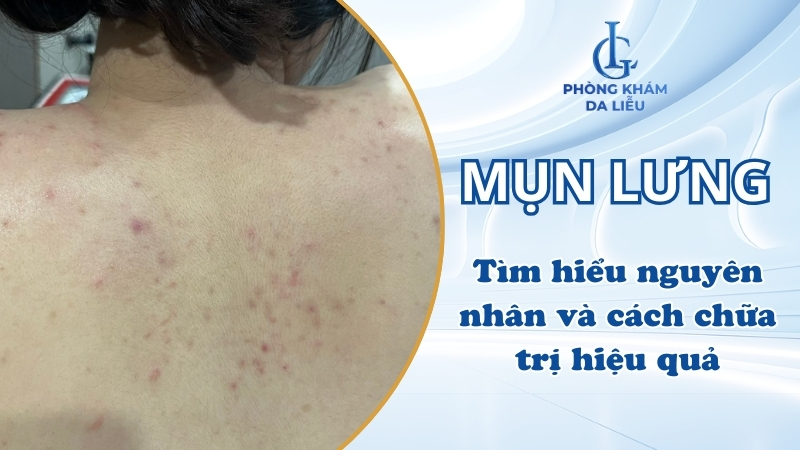 mụn lưng