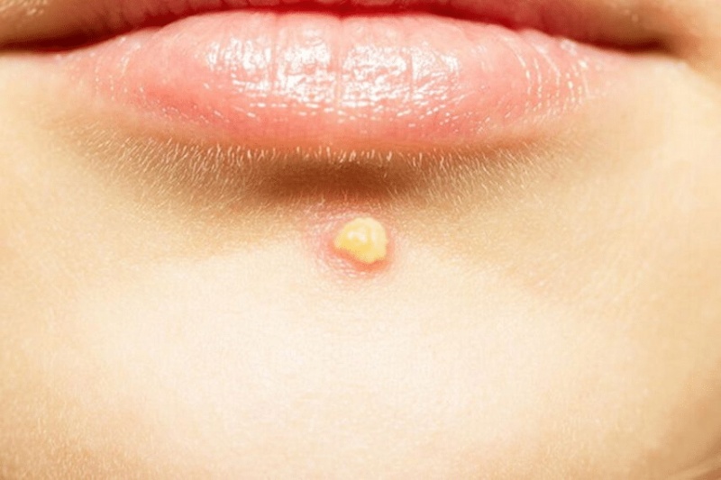 mụn mủ ở cằm