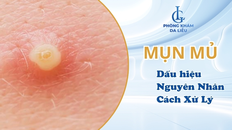 mụn mủ là gì