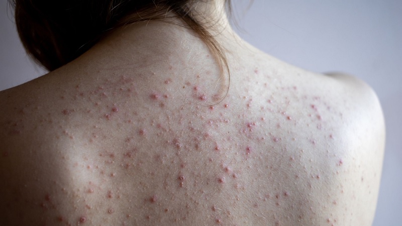 Mụn mủ ở lưng