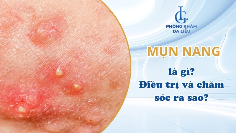 mụn nang là gì