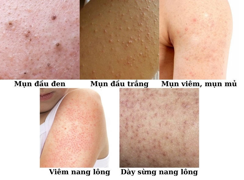 các loại mụn ở bắp tay