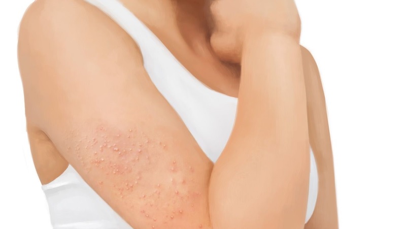 bị mụn bắp tay