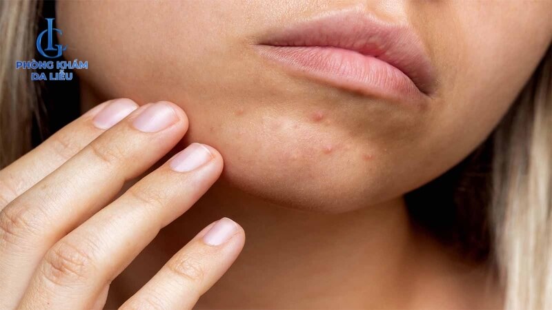 Rối loạn giấc ngủ gây nổi mụn ở cằm