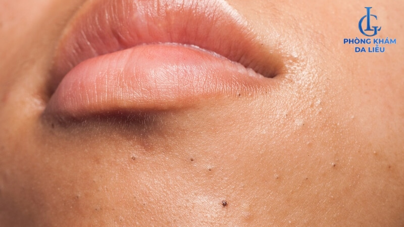 Mụn đầu đen ở cằm